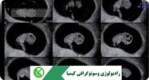  سونوگرافی سه ماهه اول بارداری